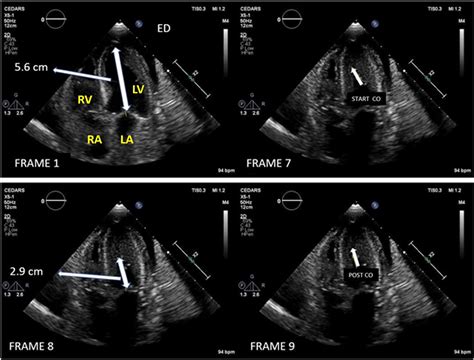 lv obliteration|Diagnostic and Prognostic Implications of Left Ventricular Cavity .